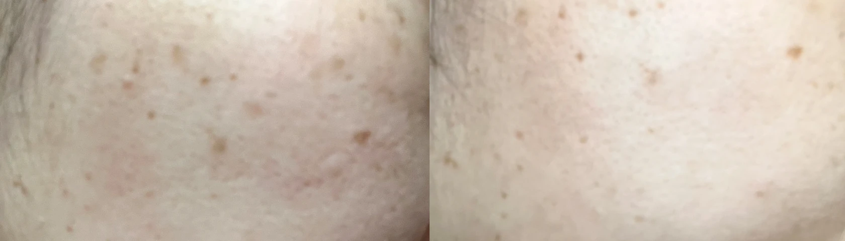 モニターM.Iさんの使用前と1ヶ月後の頬の肌の比較